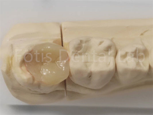Esthetische inlay en onlay in de tandheelkunde voor indirecte vulling en tandherstel