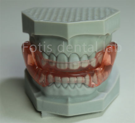 OEM orthodontische retainer expander alle maten compatibel met de meeste orthodontische behandelingen