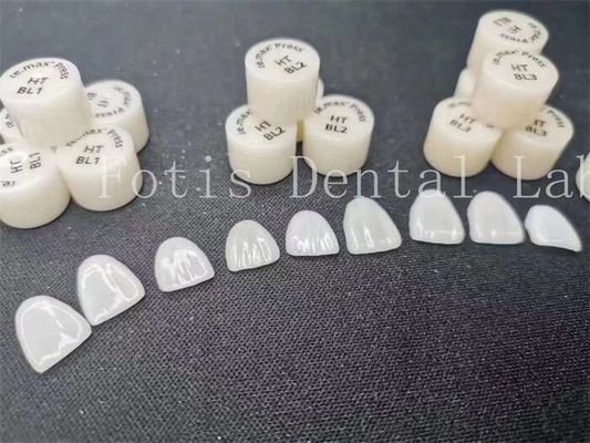 Aanpassing van tandheelkundige lab laminaat veneers met hoge vlekbestendigheid en sterkte