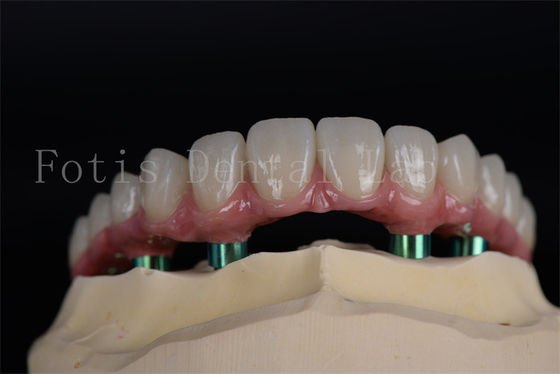 Langdurig All On 4 All On 6 Implantaten Natuurlijk uitziende esthetiek Geen leeftijdsbeperking Herstel