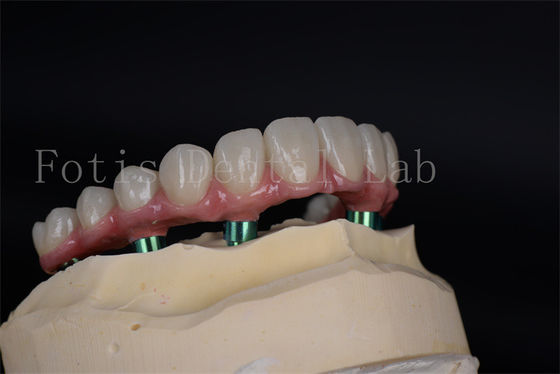Geavanceerde volledige kauwvermogenherstel Implantatieprocedure voor patiënten met een lage botdichtheid