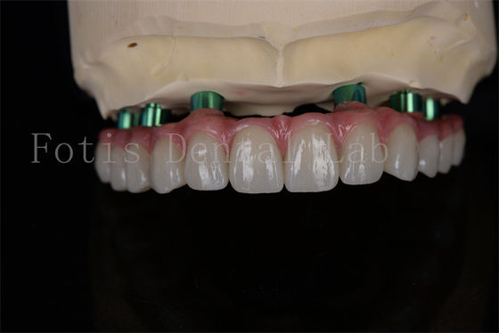 Zirconia All-on-4 Implantatieprocedure Zelfde dag Herstel Minimale follow-up nodig