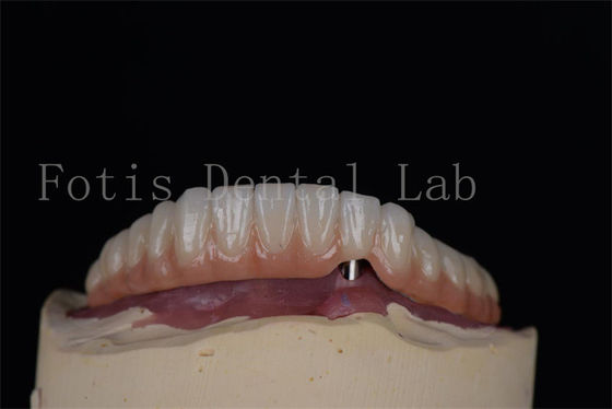 Natuurlijk uitziende tandheelkundige implantaten van titanium of zirconia Minimaal invasieve ingreep Gemakkelijk te reinigen