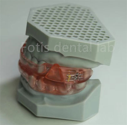 Goedkope tandheelkundige hyrax expander orthodontische retainer gemakkelijk te reinigen en onderhouden